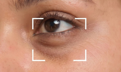 Agir sur les cernes et poches sous les yeux